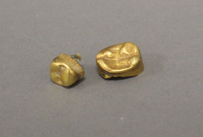 DEUX COURONNES DENTAIRES en or jaune (75...